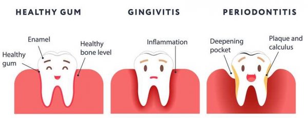 Dental Decay - Gum Disease by Smoking