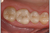 CEREC-After