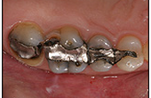 CEREC-Before