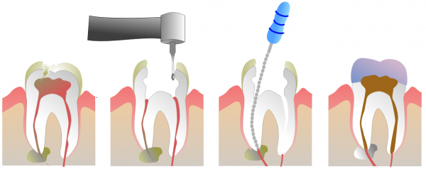 Root Canals and Crowns