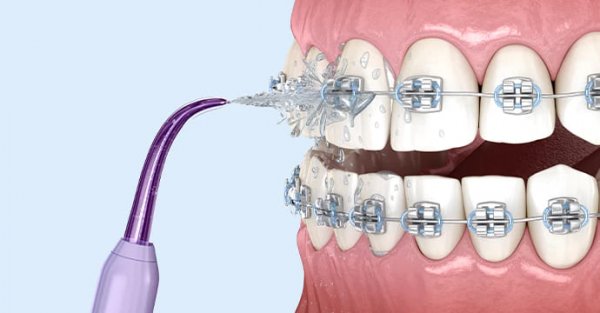 Oral irrigators or Waterpiker