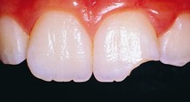 How to Fix a Chipped Tooth?