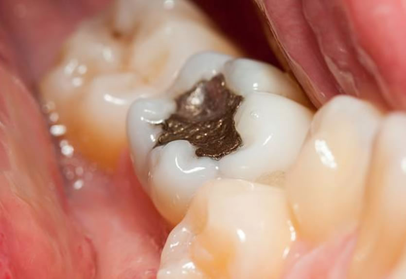 Replace amalgam fillings at Team dental